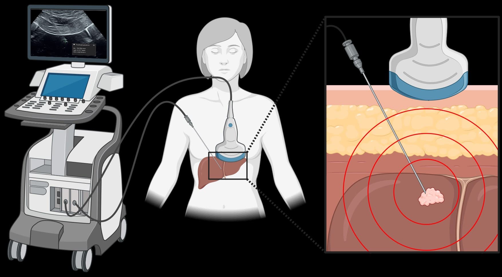 Novel Tracking-Imaging Probe